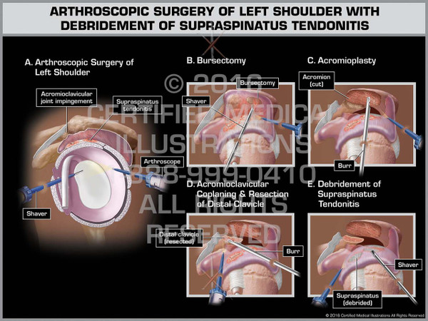 Exhibit of Arthroscopic Surgery of Left Shoulder with Debridement of Supraspinatus Tendonitis - Print Quality Instant Download
