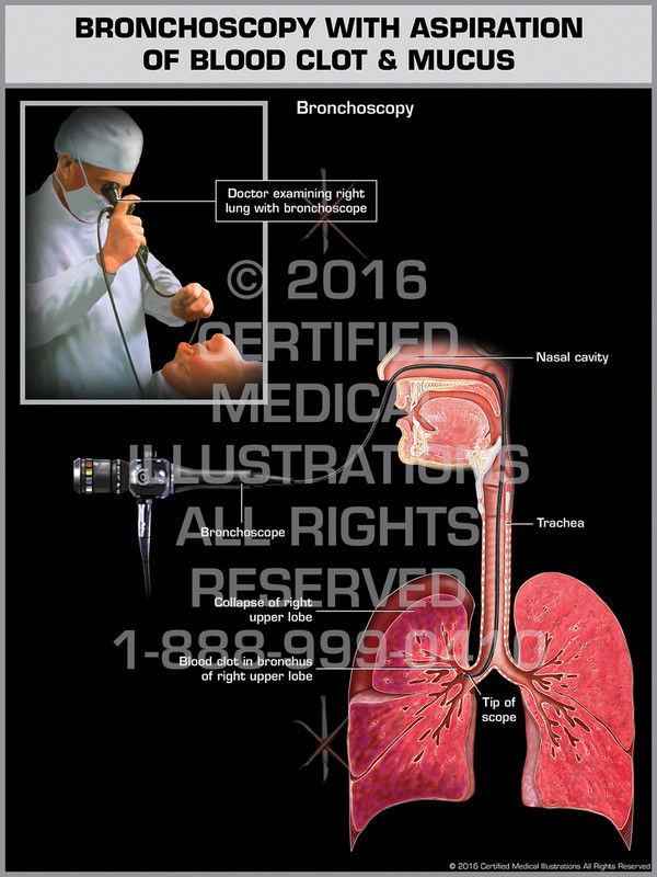 Exhibit of Bronchoscopy with Aspiration of Blood Clot & Mucus