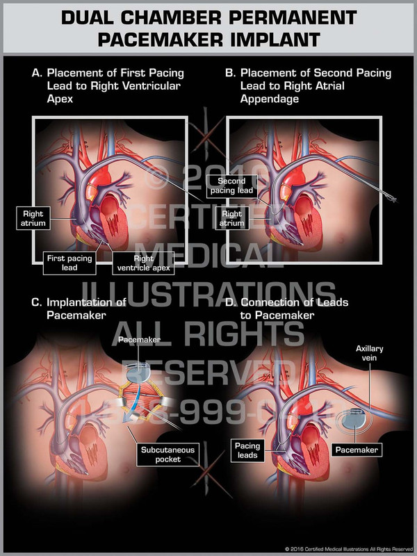 Exhibit of Dual Chamber Permanent Pacemaker Implant