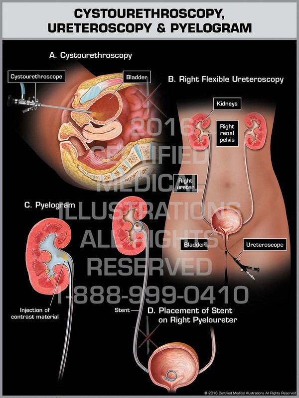 Exhibit of Cystourethroscopy, Ureteroscopy & Pyelogram - Print Quality Instant Download Exhibit of Cystourethroscopy, Ureteroscopy & Pyelogram - Print Quality Instant Download