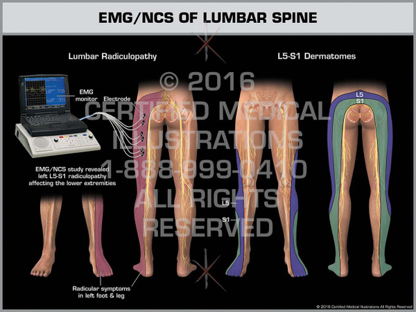 Exhibit of EMG/NCS of Lumbar Spine - Print Quality Instant Download