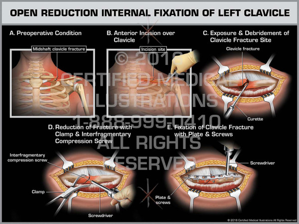 Exhibit of Open Reduction Internal Fixation of Left Clavicle