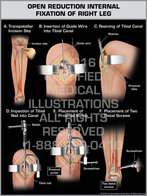 Exhibit of Open Reduction Internal Fixation of Right Leg - Print Quality Instant Download