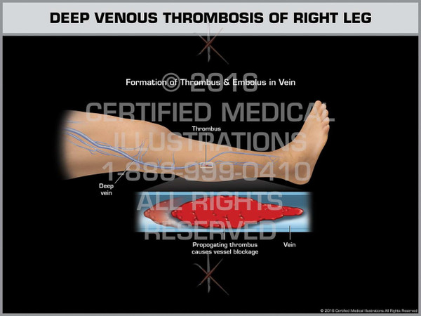 Exhibit of Deep Venous Thrombosis of Right Leg - Print Quality Instant Download