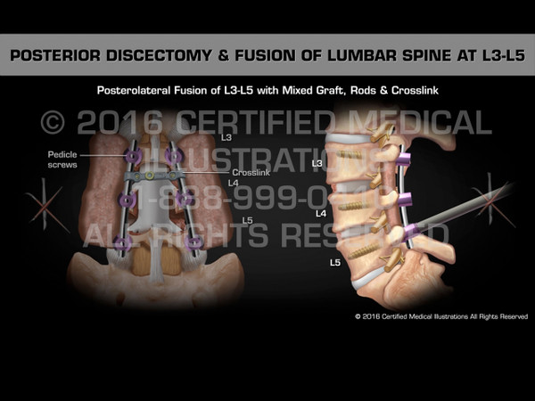 Animation of Posterior Discectomy & Fusion of Lumbar Spine at L3-L5