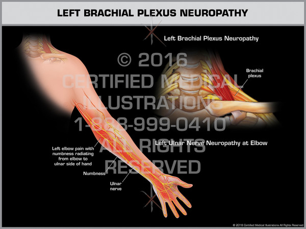 Exhibit of Left Brachial Plexus Neuropathy