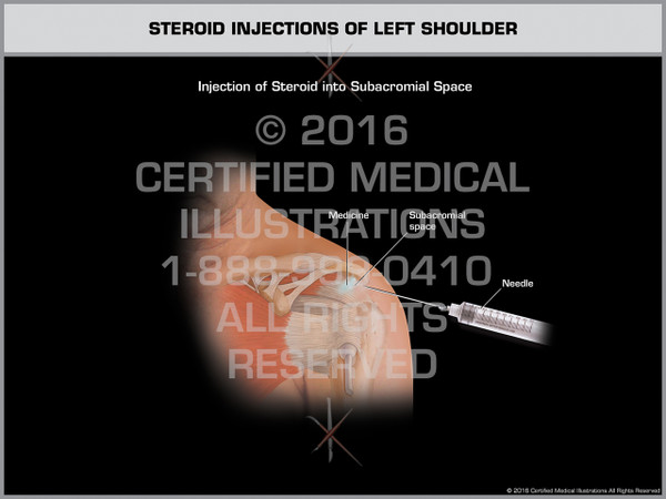 Exhibit of Steroid Injections of Left Shoulder - Print Quality Instant Download