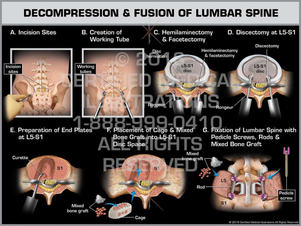 Exhibit of Decompression & Fusion of Lumbar Spine