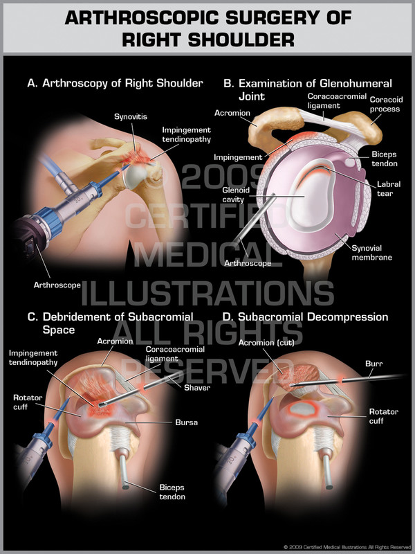 Exhibit of Arthroscopic Surgery of Right Shoulder.