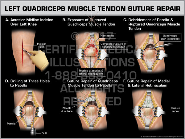 Exhibit of Left Quadriceps Muscle Tendon Suture Repair - Print Quality Instant Download