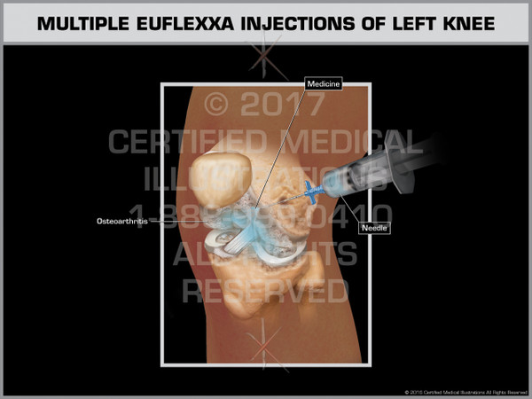 Exhibit of Multiple Euflexxa Injections of Left Knee - Print Quality Instant Download