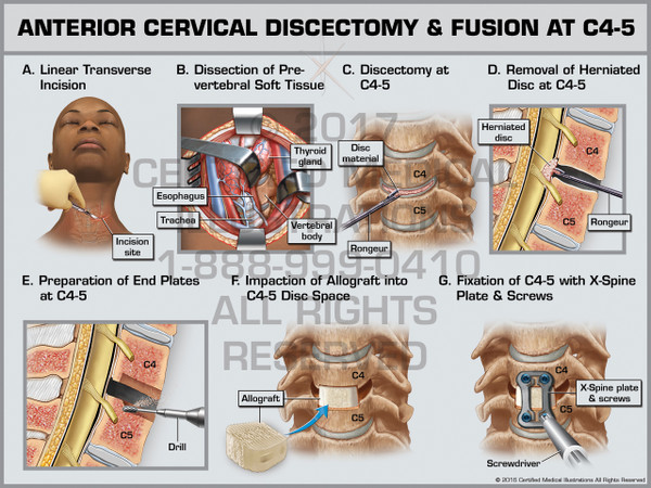 Exhibit of Anterior Cervical Discectomy & Fusion at C4-5