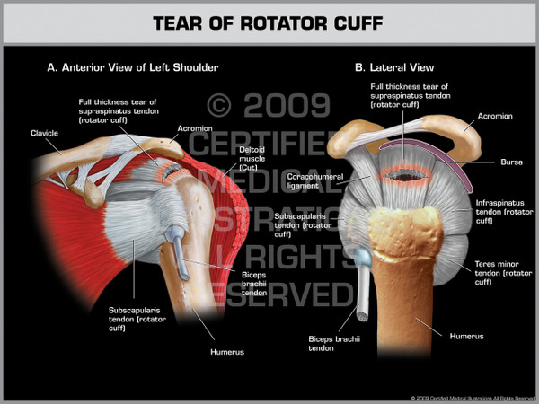 Exhibit of Tear of Rotator Cuff - Left.