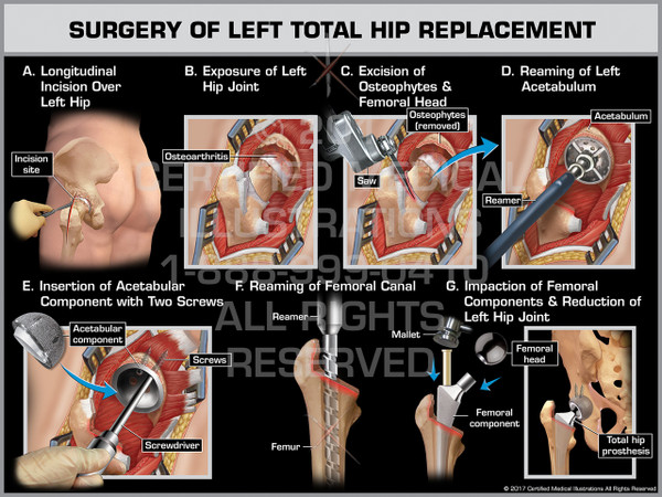 Surgery of Left Total Hip Replacement