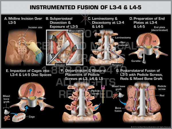 Instrumented fusion of L3-4 & L4-5 - Print Quality Instant Download