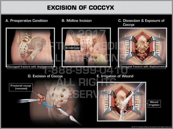 Exhibit of Excision of Coccyx