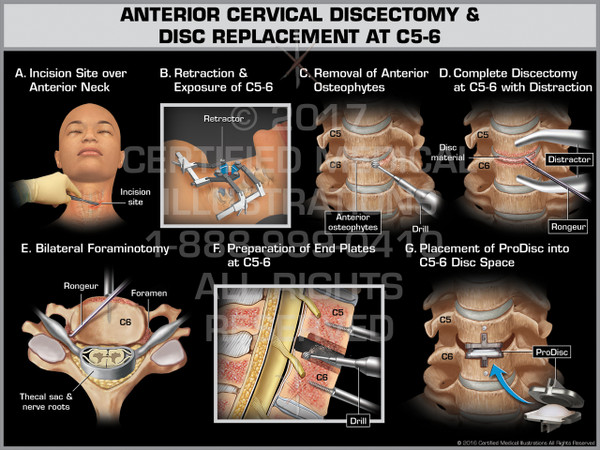 Exhibit of Anterior Cervical Discectomy & Replacement at C5-6 - Print Quality Instant Download
