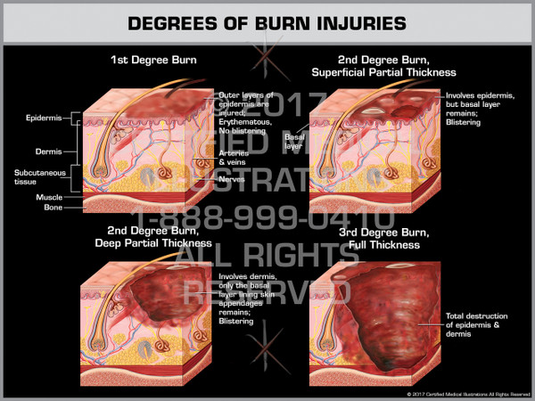 Exhibit of Degrees of Burn Injuries