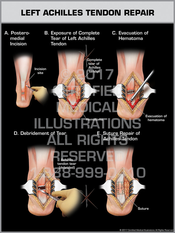 Exhibit of Left Achilles Tendon Repair