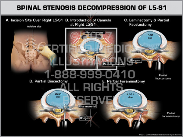 Exhibit of Spinal Stenosis Decompression of L5-S1 - Print Quality Instant Download