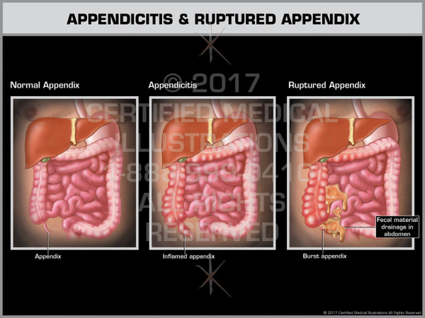 Exhibit of Appendicitis & Ruptured Appendix
