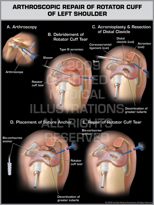 Exhibit of Arthroscopic Repair of Rotator Cuff of Left Shoulder.