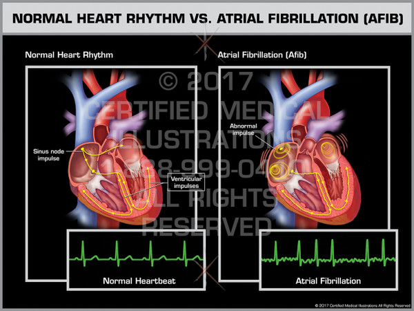 Exhibit of Normal Heart Rhythm vs. Atrial Fibrillation (AFIB)