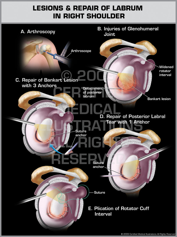 Exhibit of Lesions & Repair of Labrum in Right Shoulder.