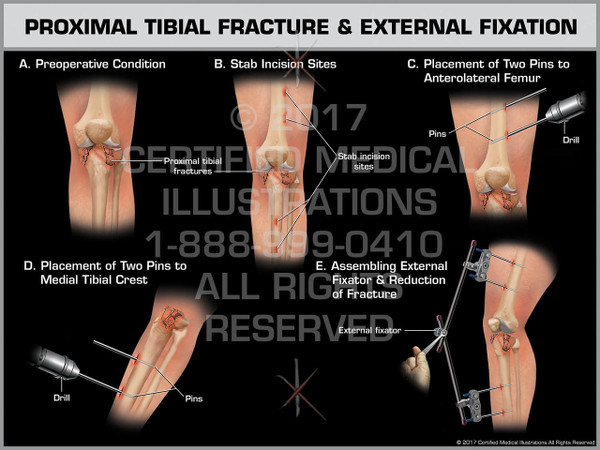 Exhibit of Proximal Tibial Fracture & External Fixation