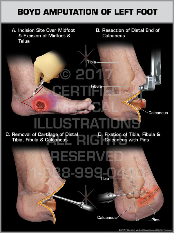 Exhibit of Boyd Amputation of Left Foot