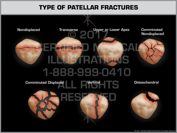 Exhibit of  Type of Patellar Fractures