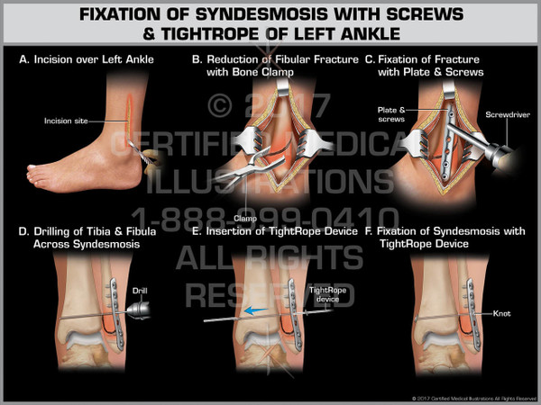 Exhibit of Fixation of Syndesmosis with Screws & Tightrope of Left Ankle Exhibit of Fixation of Syndesmosis with Screws & Tightrope of Left Ankle