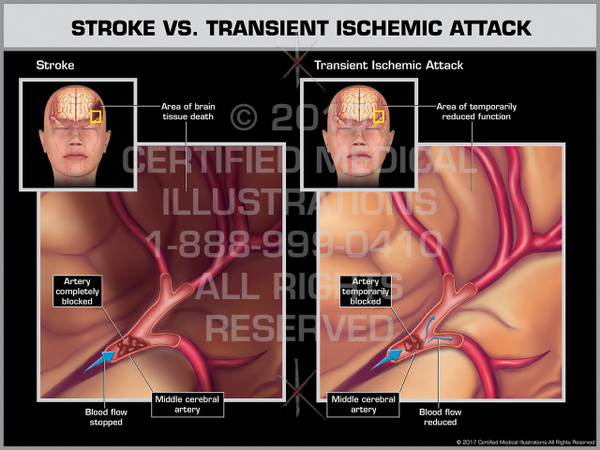 Stroke Vs. Transient Ischemic Attack
