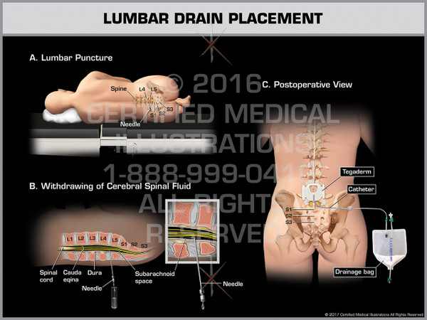 Lumbar Drain Placement - Print Quality Instant Download