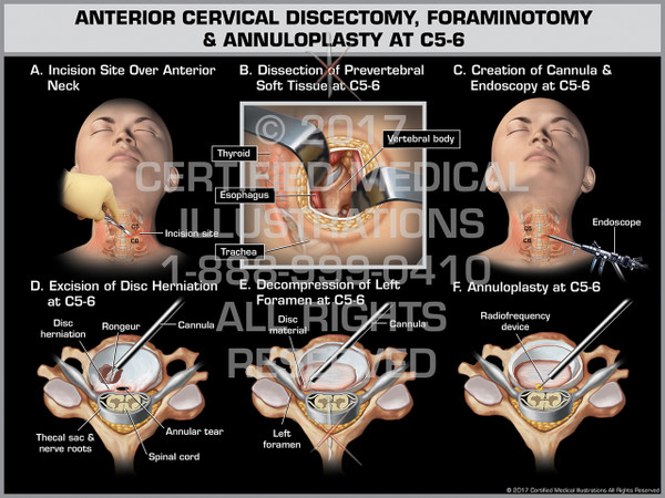Anterior Cervical Discectomy, Foraminotomy, & Annuloplasty at C5-6