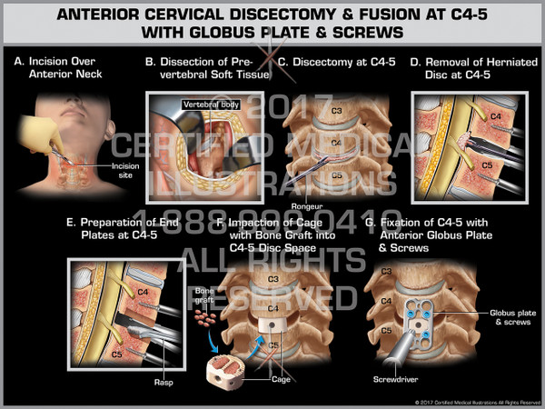 Exhibit of Anterior Cervical Discectomy & Fusion at C4-5 with Globus Plate & Screws