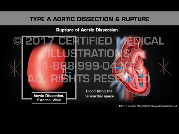Animation of Type A Aortic Dissection & Rupture