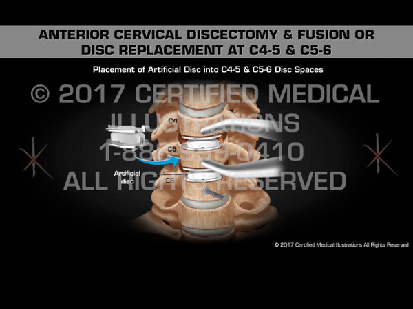 Animation of Anterior Cervical Discectomy & Fusion or Disc Replacement at C4-5 & C5-6