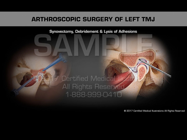 Arthroscopic Surgery of Left TMJ