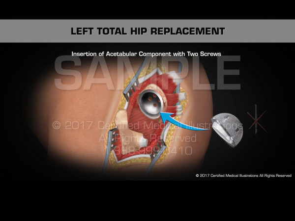 Left Total Hip Replacement Animation