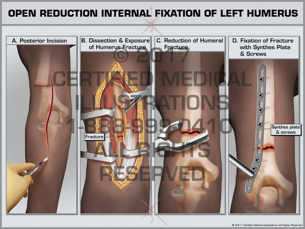 Open Reduction Internal Fixation of Left Humerus 