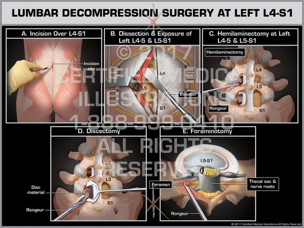 Lumbar Decompression Surgery at Left L4-S1- Print Quality Instant Download