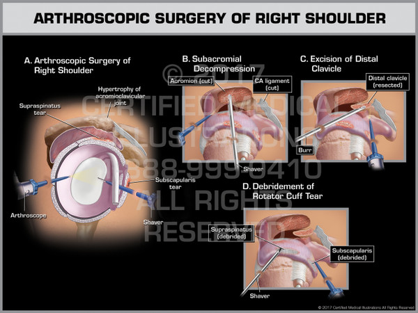 Exhibit of Arthroscopic Surgery of Shoulder- Print Quality Instant Download