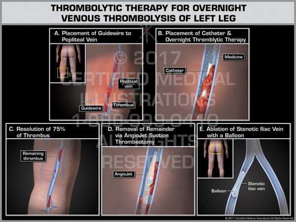 Exhibit of Thrombolytic Therapy for Overnight Venous Thrombolysis of Left Leg