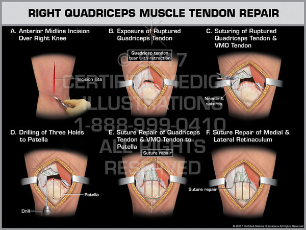 Exhibit of Right Quadriceps Muscle Tendon Repair