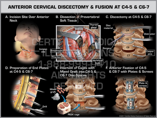 Exhibit of Anterior Cervical Discectomy & Fusion at C4-5 & C6-7