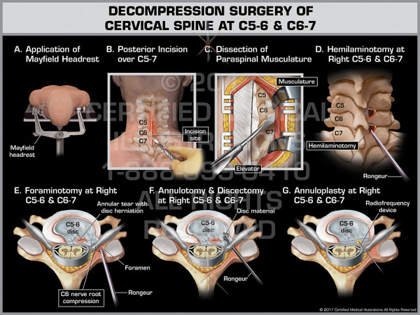 Exhibit of Decompression Surgery of Cervical Spine at C5-6 & C6-7- Print Quality Instant Download