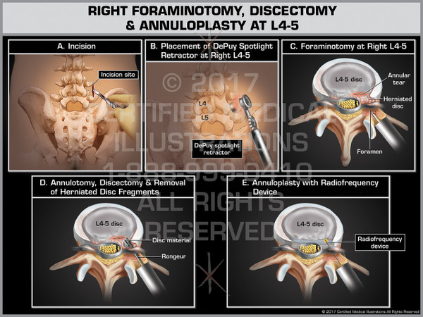 Exhibit of Right Foraminotomy, Discectomy & Annuloplasty at L4-5- Print Quality Instant Download