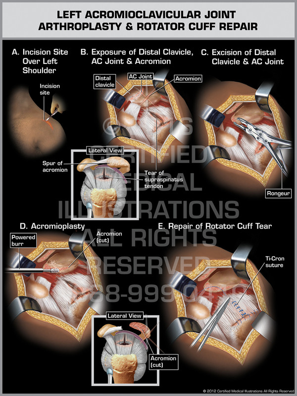 Exhibit of Left Acromioclavicular Joint Arthroplasty & Rotator Cuff Repair.
