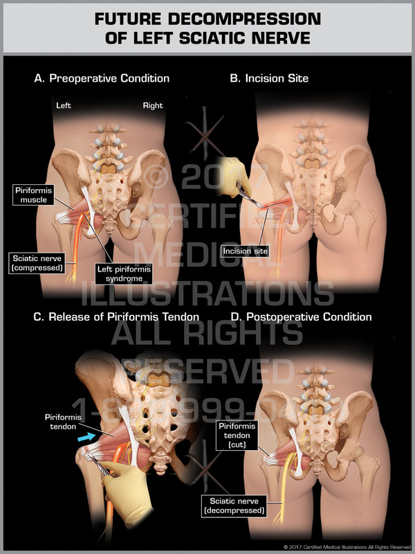 Exhibit of  Future Decompression of Left Sciatic Nerve